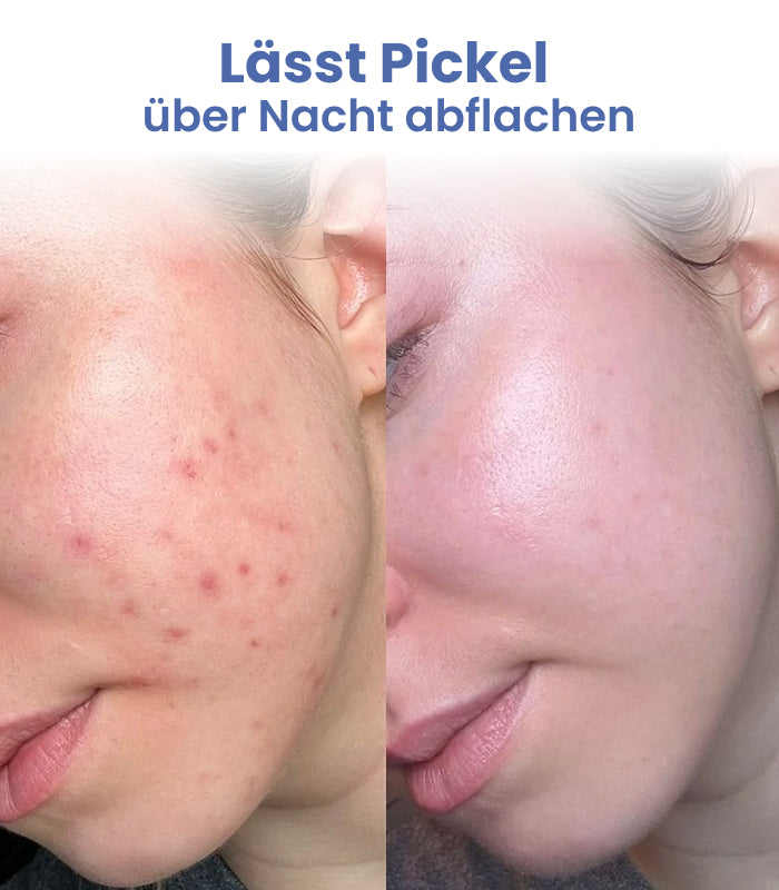 DermaStrip | Hydrokolloid-Rolle gegen Akne & Narben